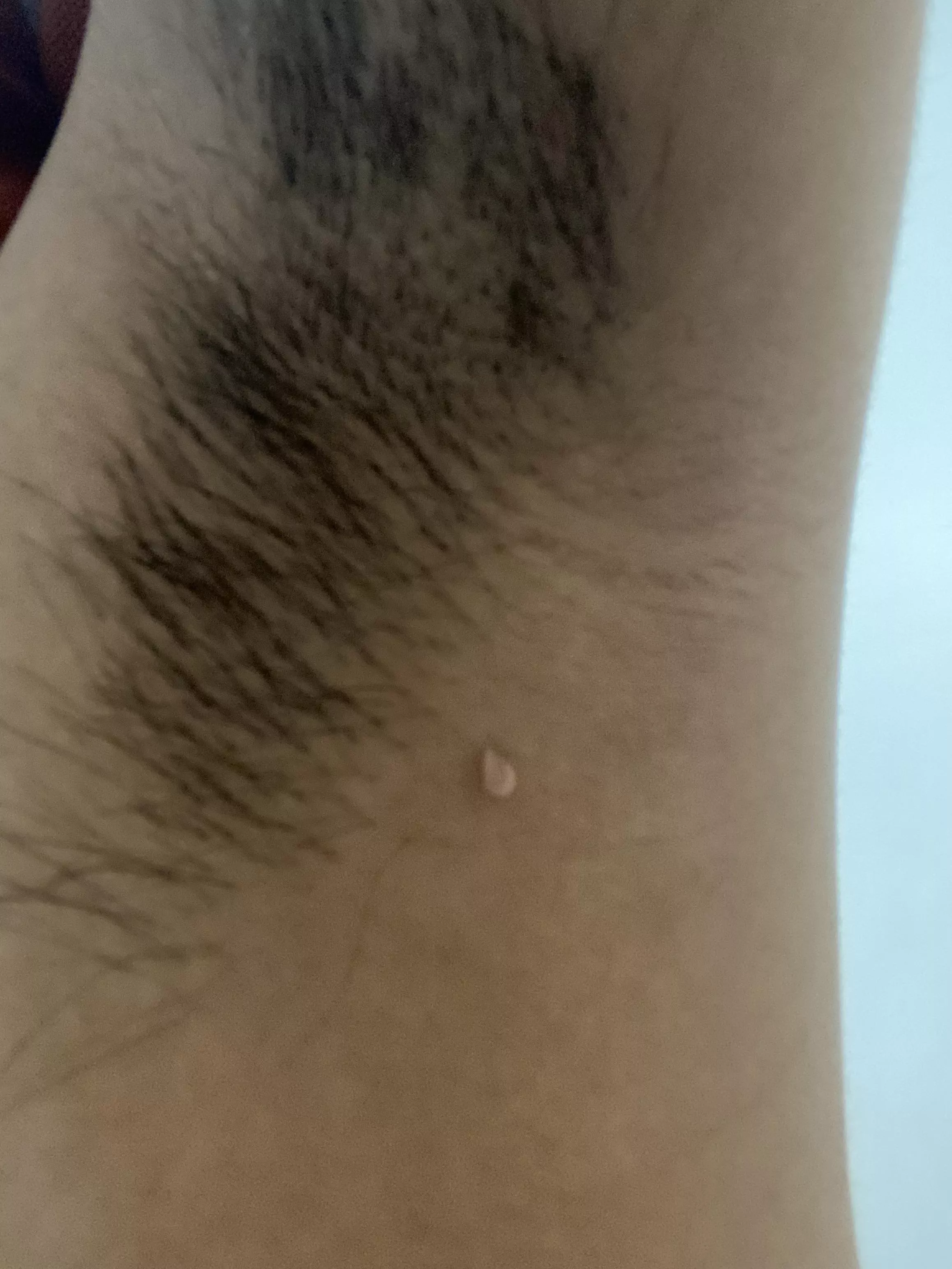 “Loose pimple” like thing under armpit