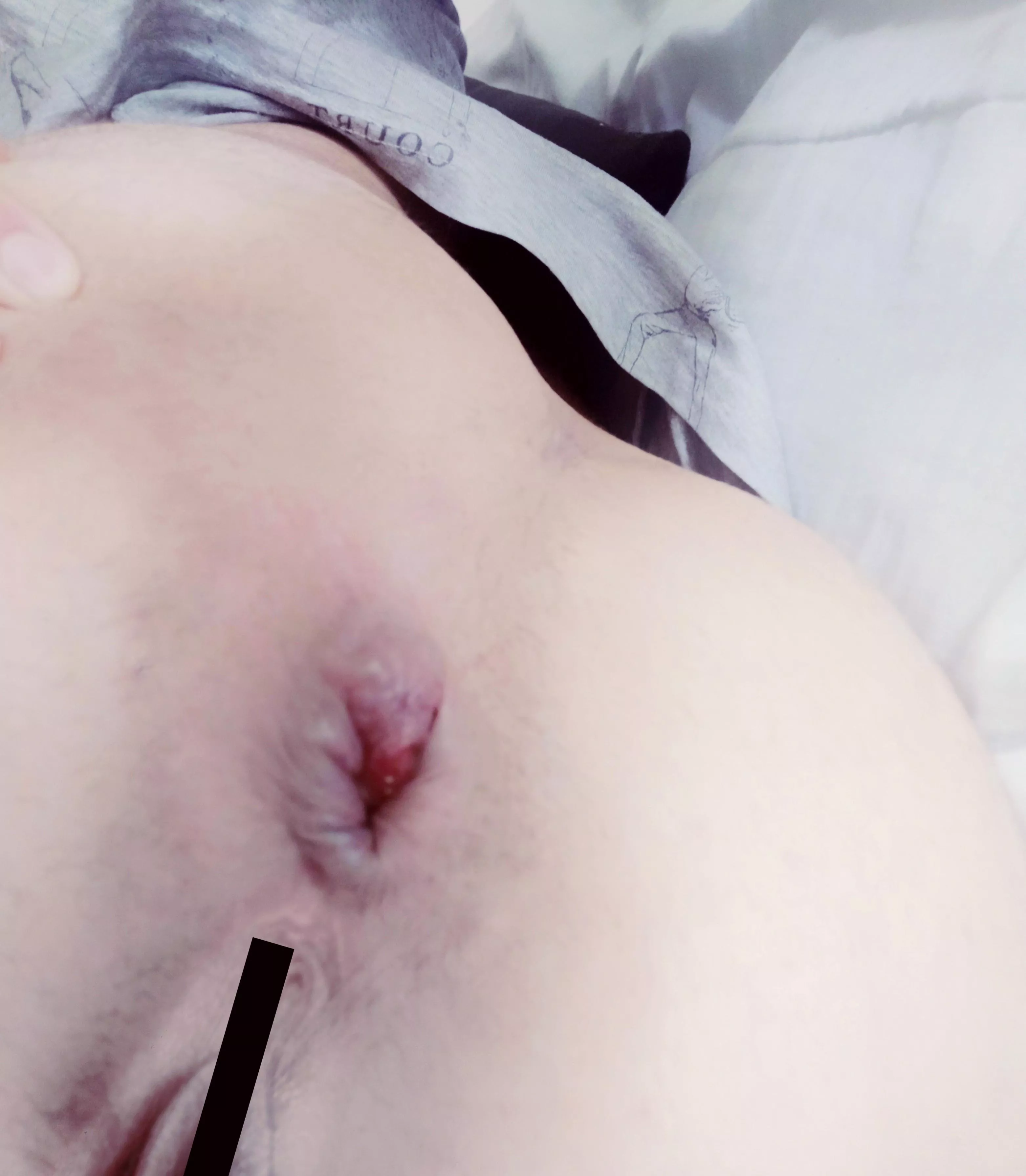 This is how my 28 yr old butthole looks now (oc) f 28