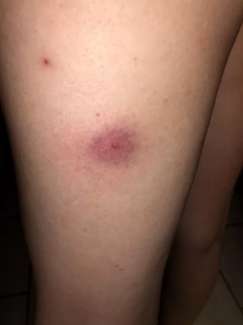 Hormonal pimple on the back of my thigh from birth control patch…