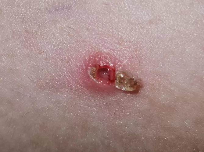 Partner's deep armpit pimple finally popped