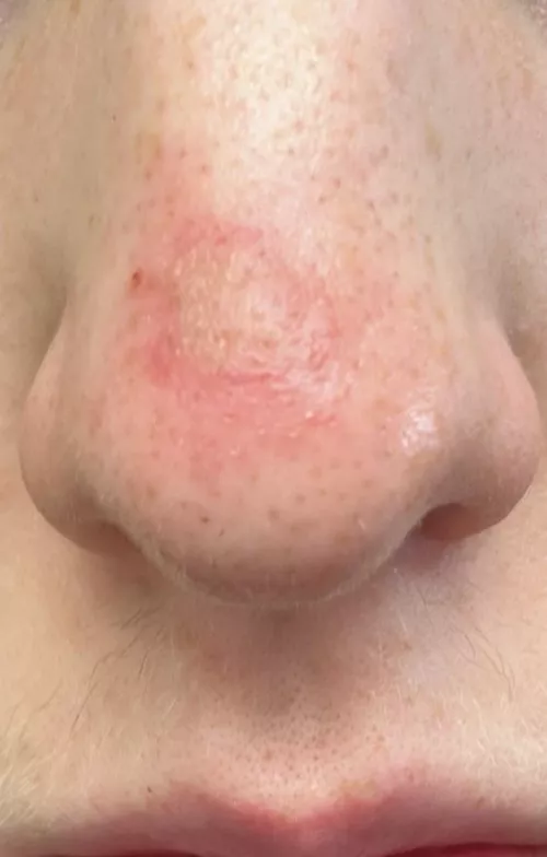 Is this infected? I popped a big blackhead on my nose yesterday and it turned into this