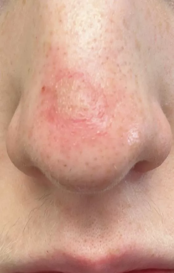 Is this infected? I popped a big blackhead on my nose yesterday and it turned into this