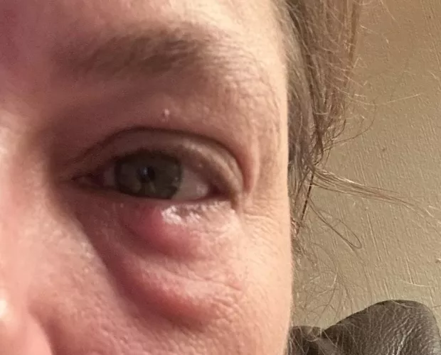 The forbidden pop - Eye stye