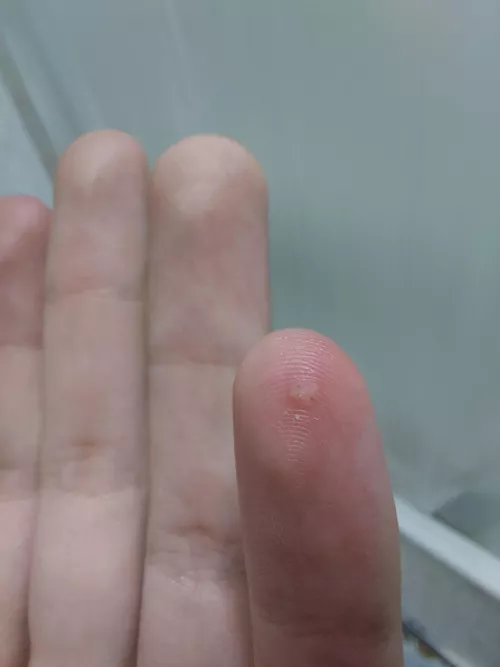 This weird bubble appeared on my finger suddenly, is it a bug growing inside me like a fly, and should I pop it?