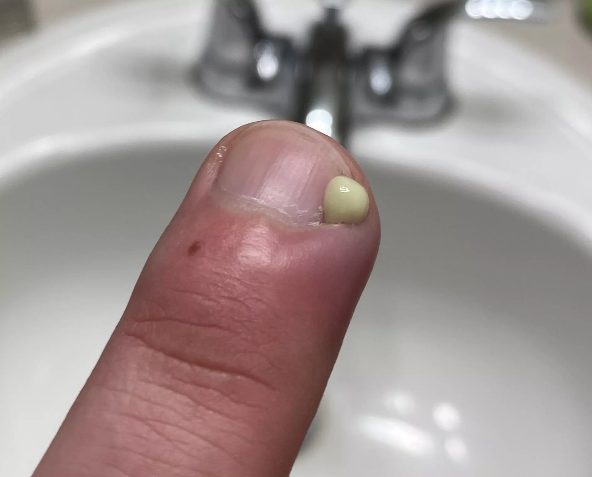 Was hoping this fucker went away on its own, but had to take matters into my own hands (literally)