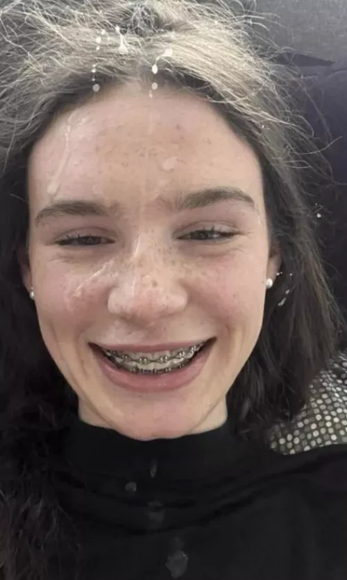 The Braces Need A Load Or Two