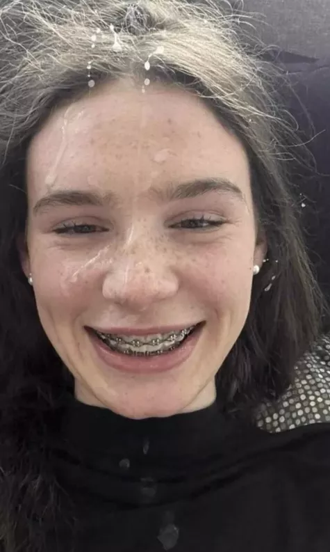 The Braces Need A Load Or Two