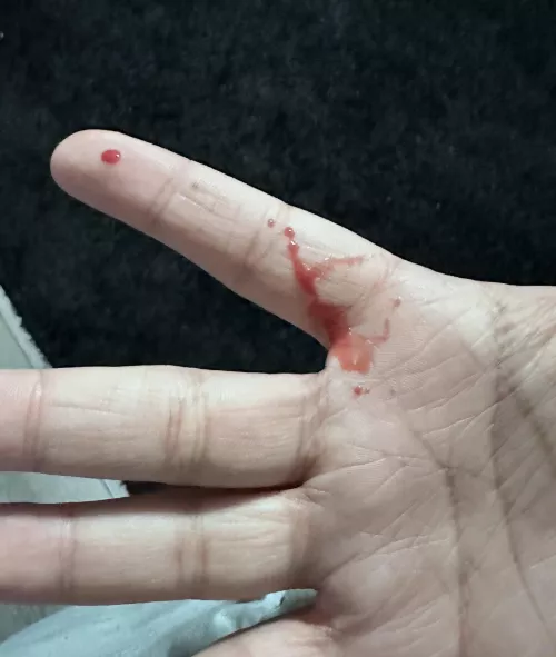 Aftermath of a pimple/boil