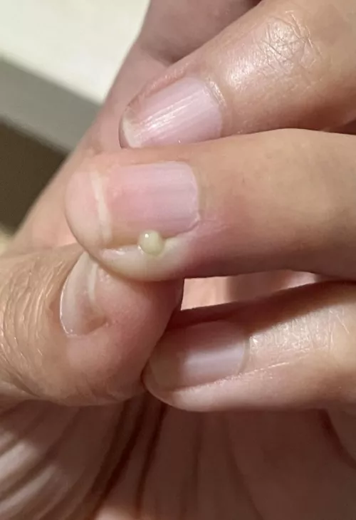 Used a (sterilised) needle to pop and it felt nice