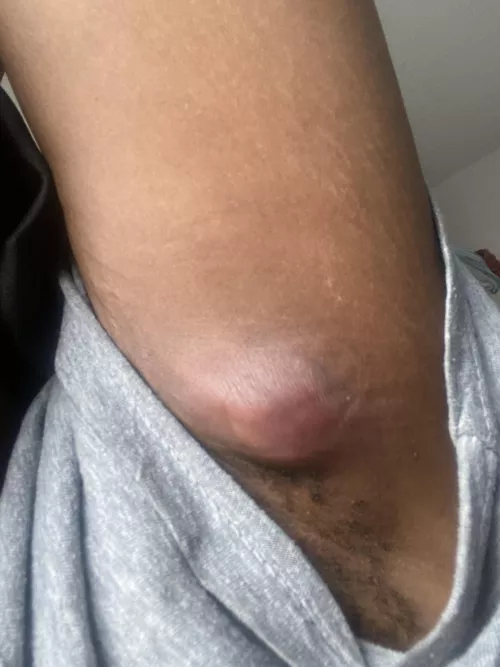 Armpit abscess - named it Parry