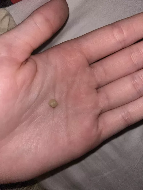 got the biggest tonsil stone i’ve ever gotten
