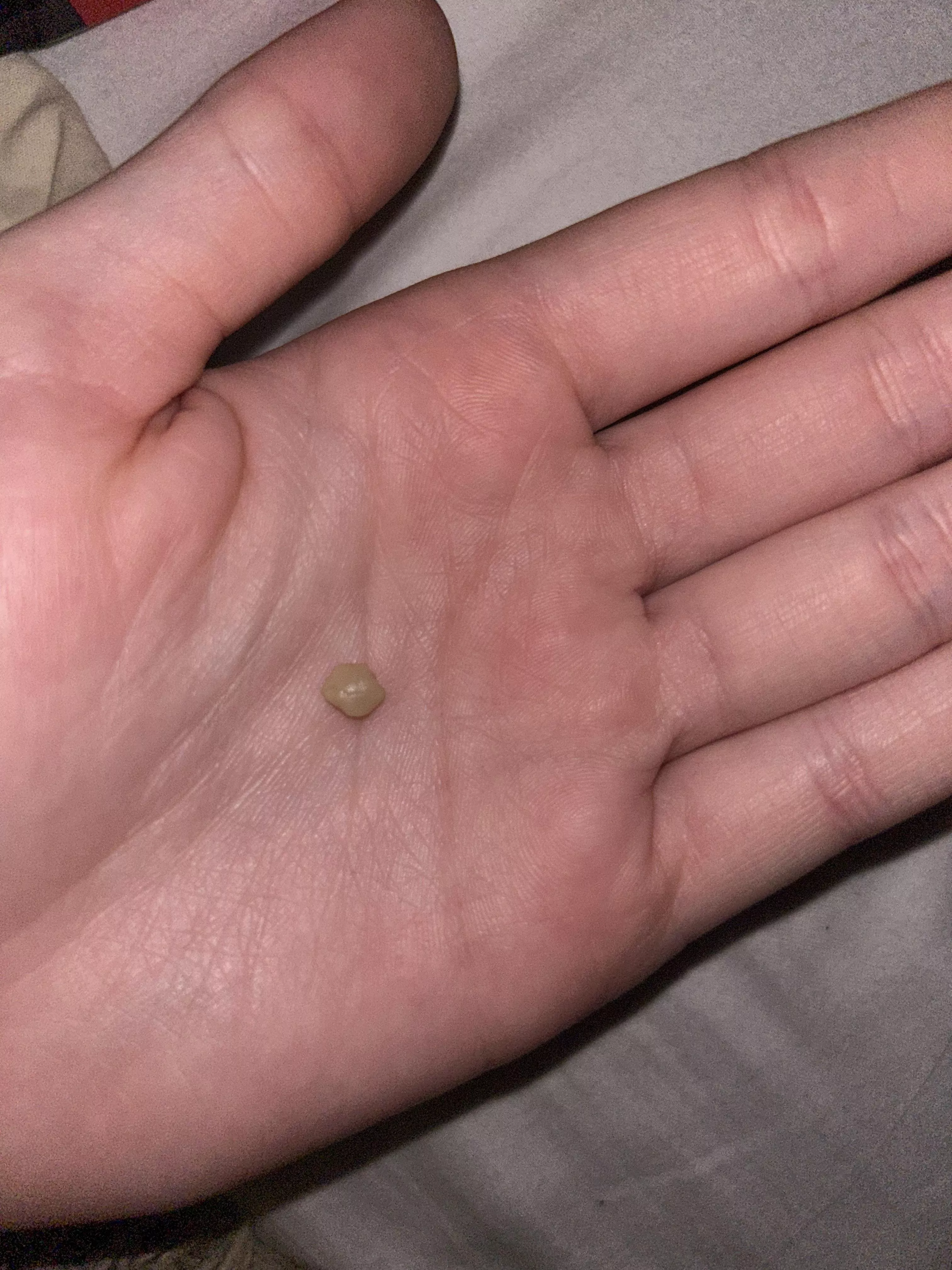 got the biggest tonsil stone i’ve ever gotten