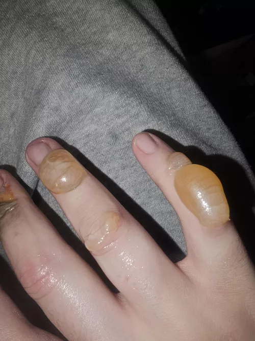 Have been told to avoid popping these, my urges have never been greater though 😭