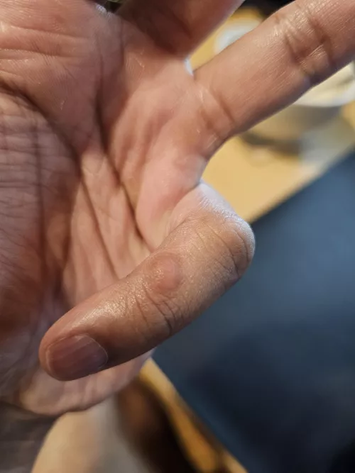 Anyone knows what this bump might be?