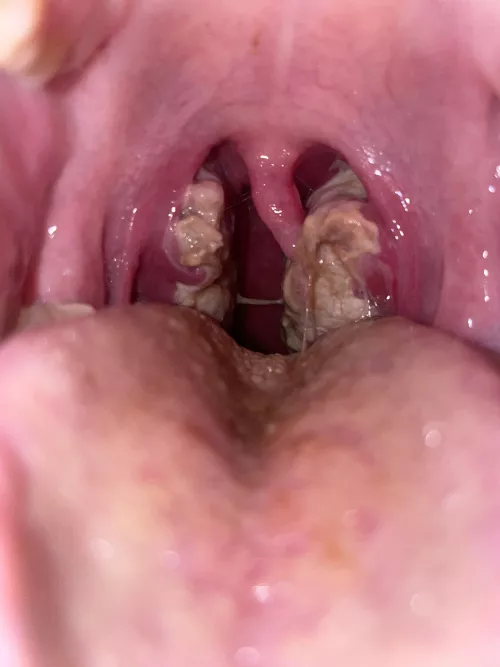 tonsils during mono OC