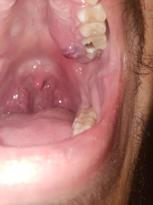 Broken Tooth abcess - hurts like an SOB.