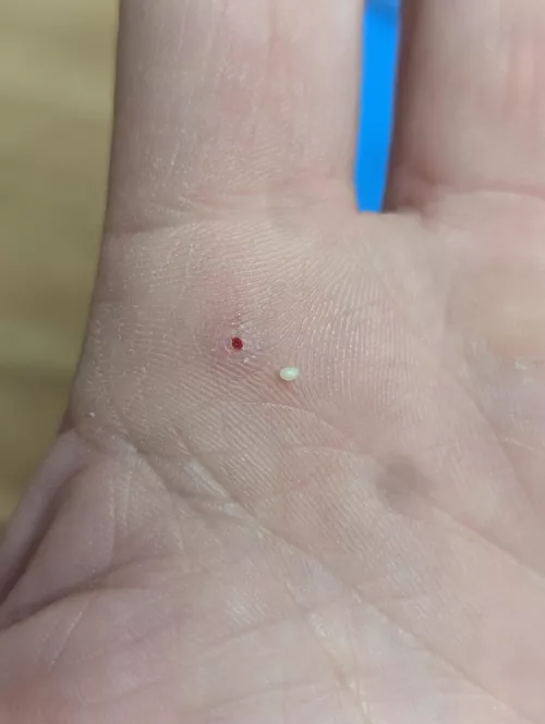 Thought I had a splinter, but this little guy came out instead. It's hard like a rock.