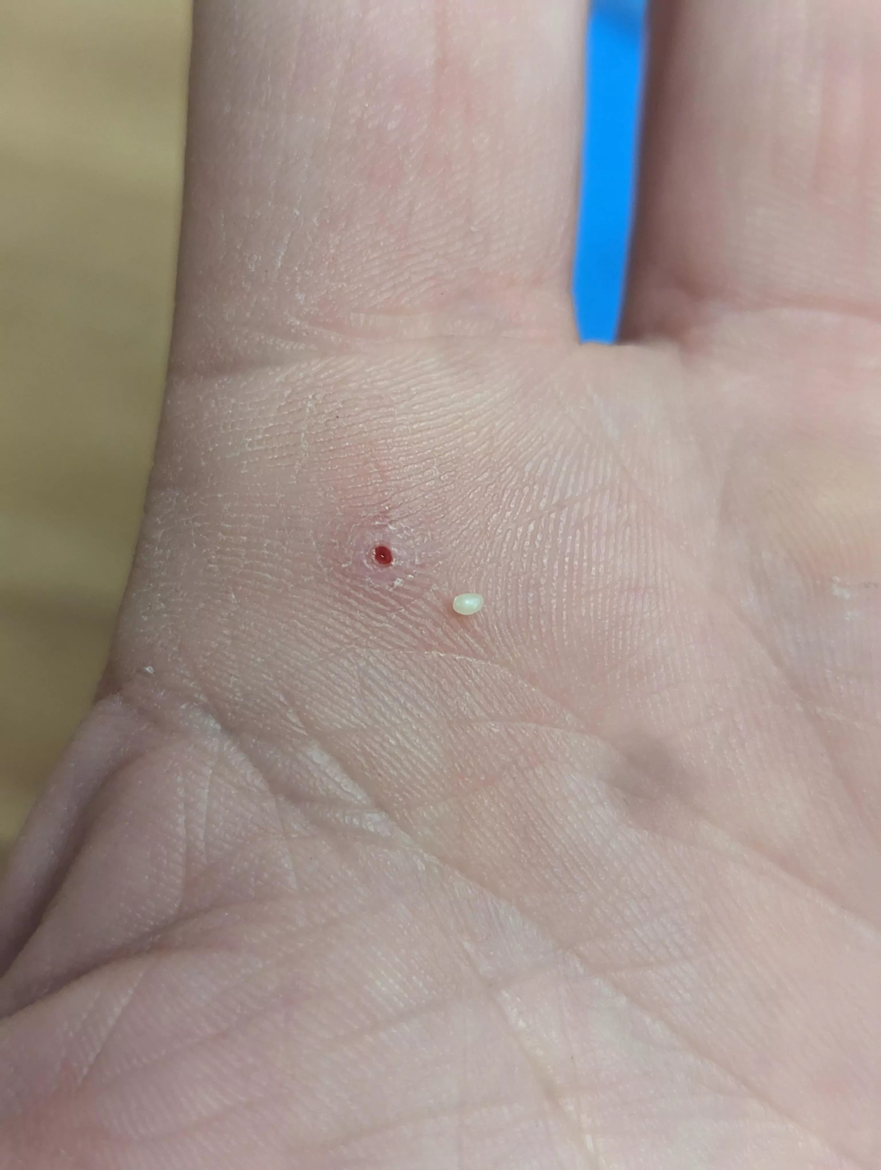 Thought I had a splinter, but this little guy came out instead. It's hard like a rock.