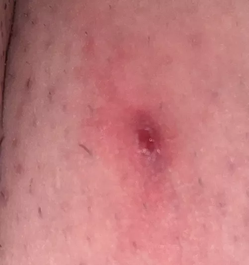 Beyond painful boil/cyst on inner thigh.