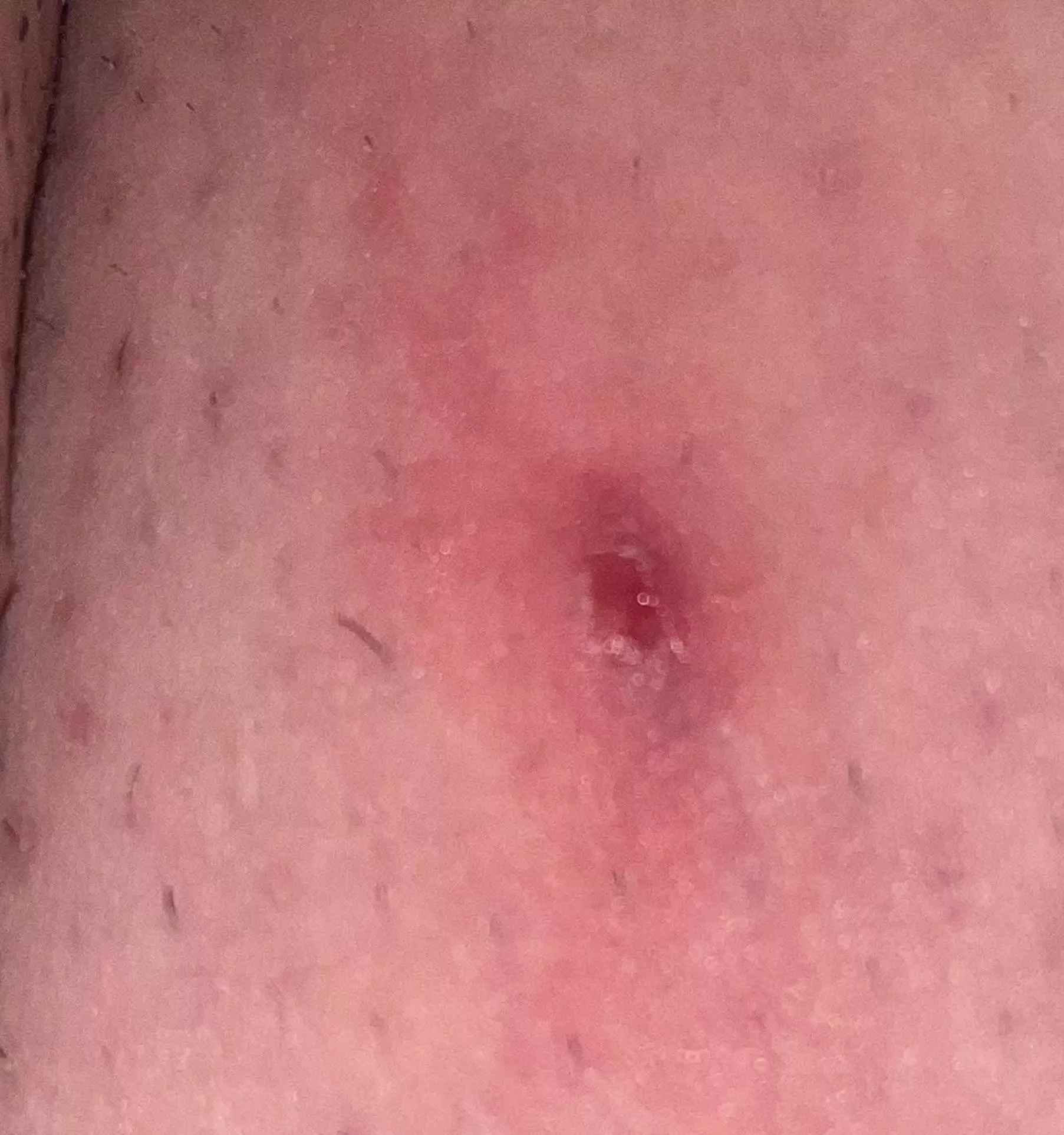 Beyond painful boil/cyst on inner thigh.