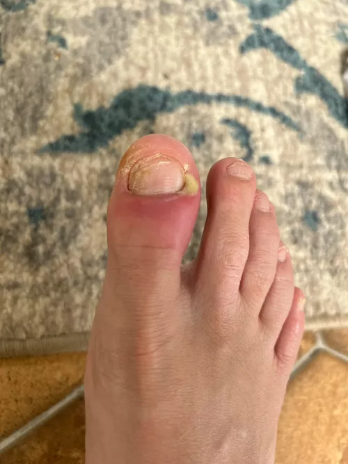 Brutal toe pop Coming up