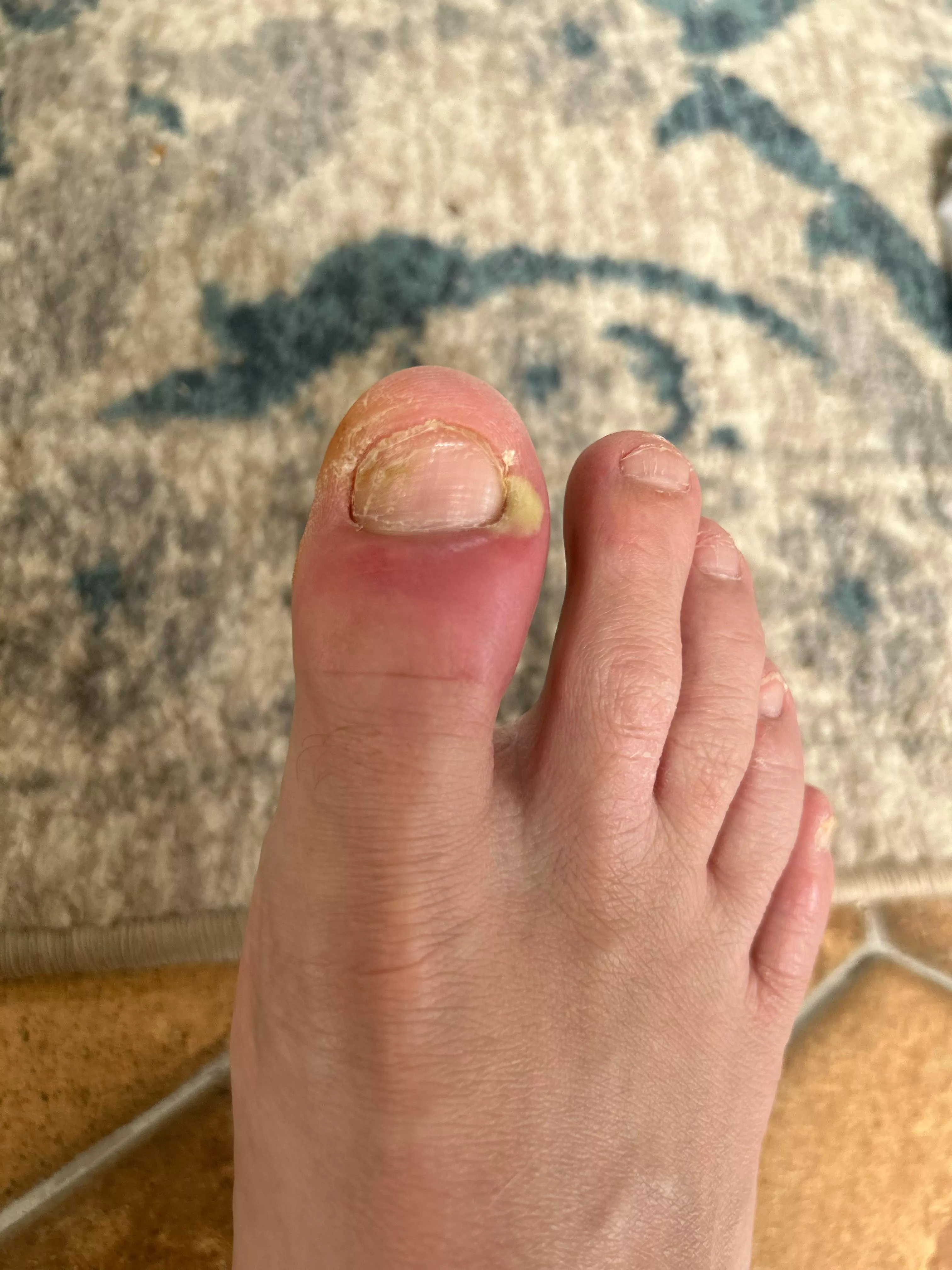Brutal toe pop Coming up