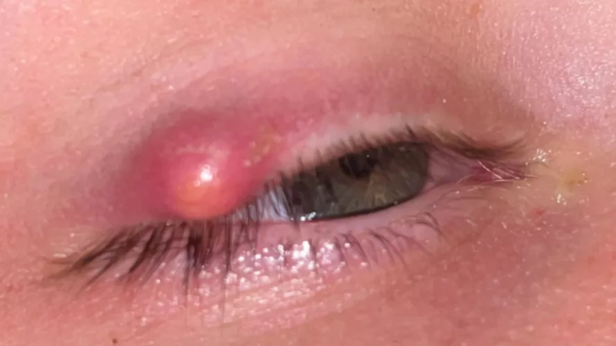 Nasty Stye I just want to squeeze it