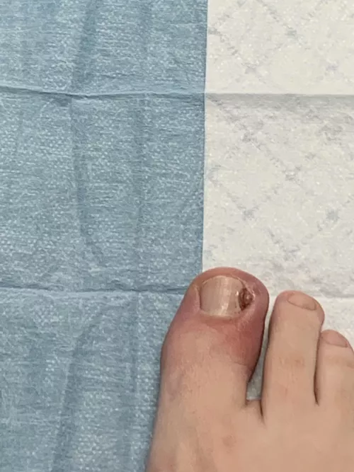 Ingrown toenail with staph