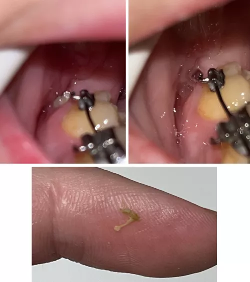 Before and after of a bone fragment that finally made its way out of my jaw from surgery 4 months ago
