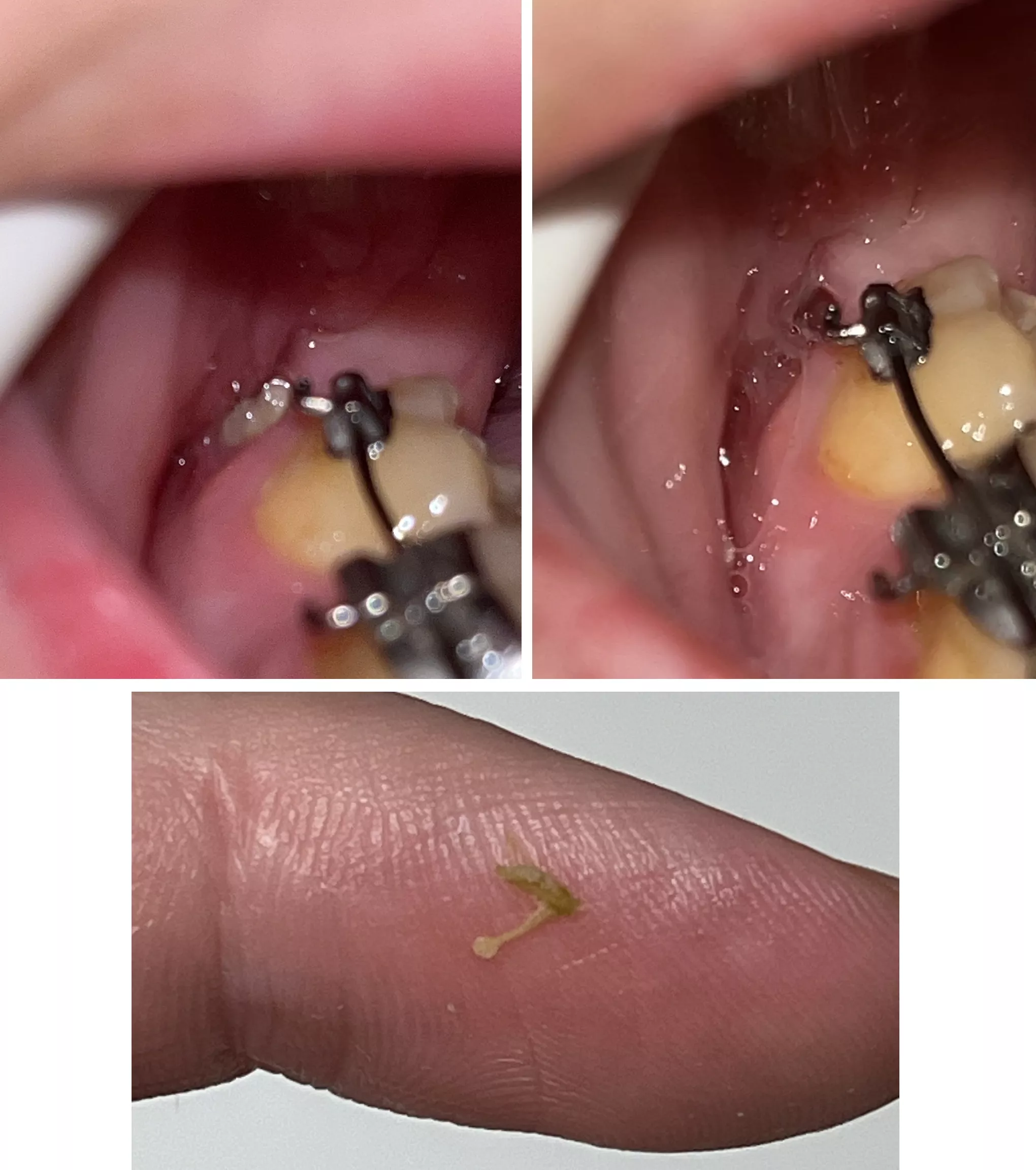 Before and after of a bone fragment that finally made its way out of my jaw from surgery 4 months ago