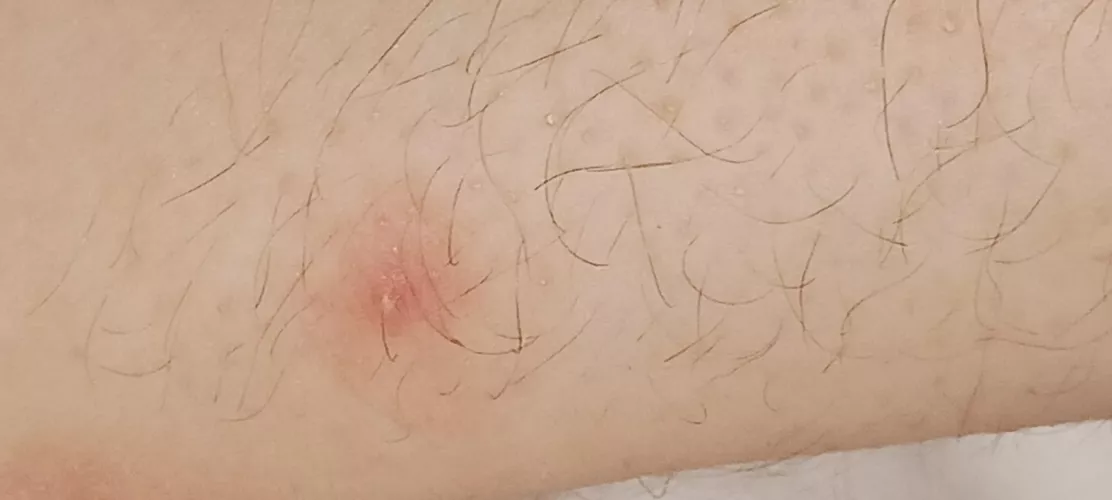 Found this very painful and annoying bump on my ankle, wondering if i should pop it.