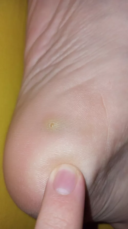 This fucker's been bothering me for the better part of two months, I've tried some removal bandaids but i think I'll just rip it out