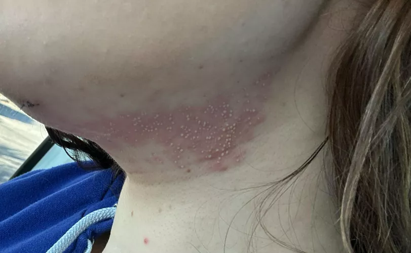Forbidden pops - folliculitis after chin lipo