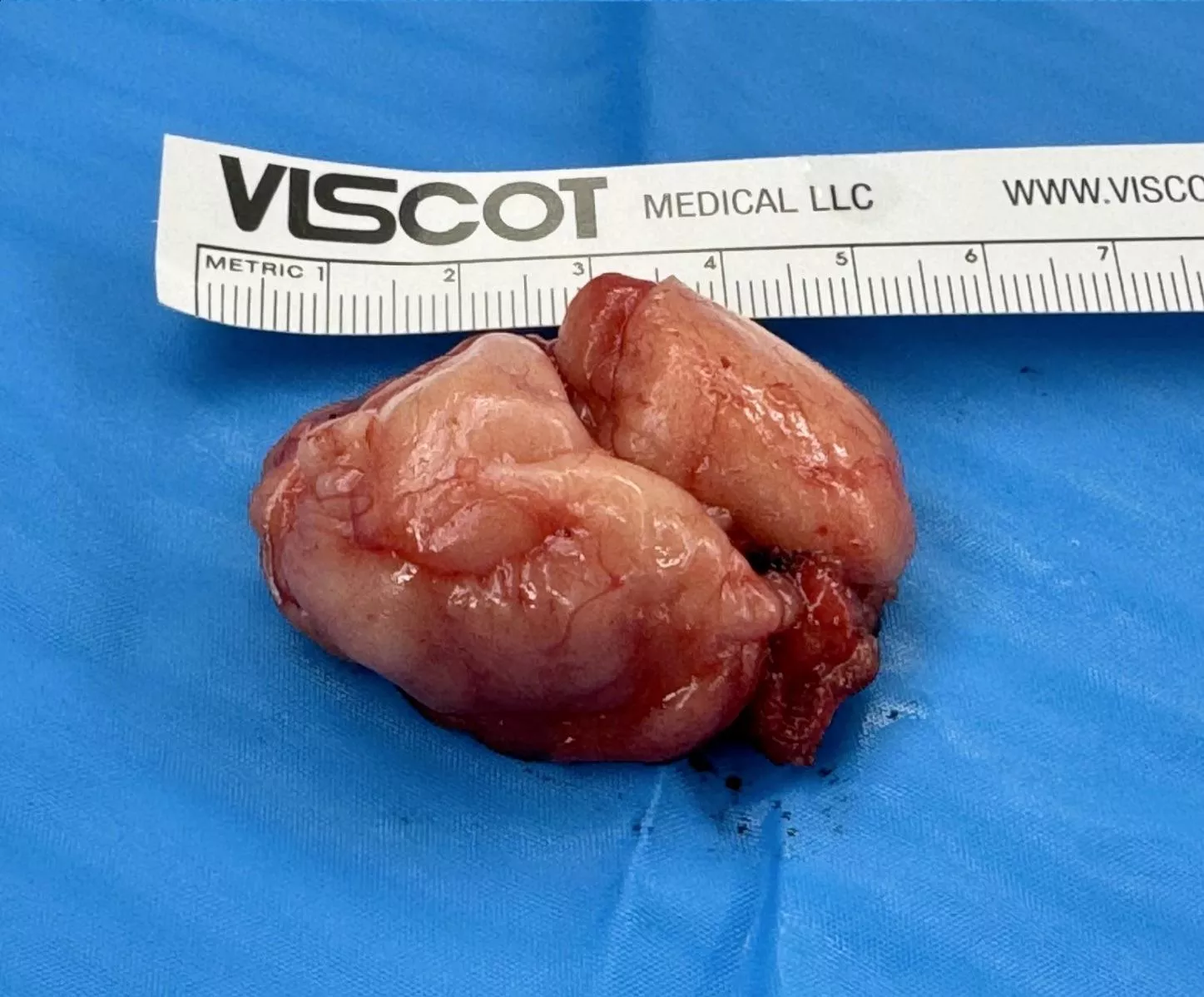 Got a lipoma removed from my neck