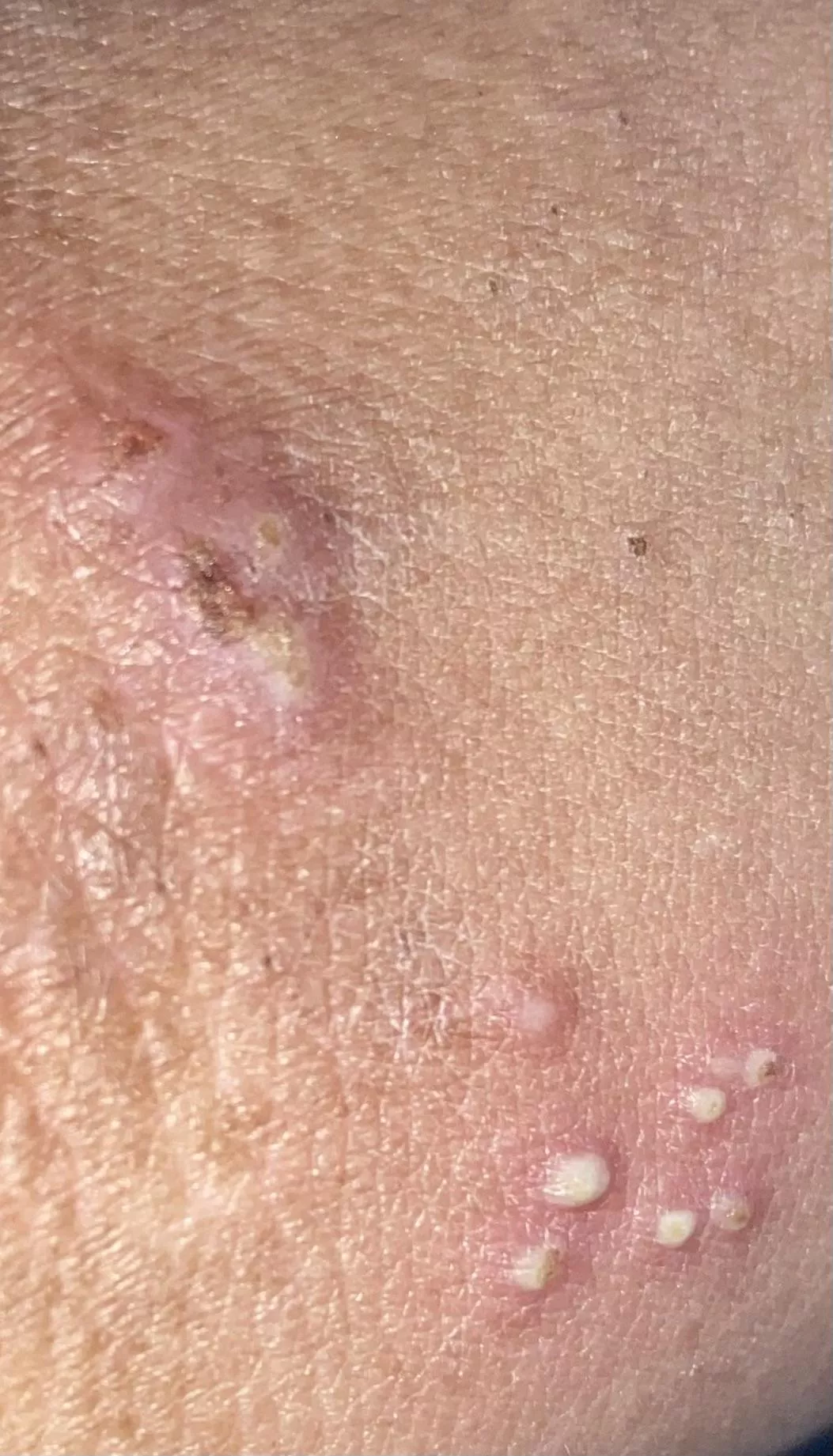 My eczema patch on the crease of my arm. Woke up with inflamed impetigo.