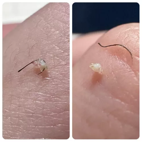 Pubic region ingrown was juicier than I expected