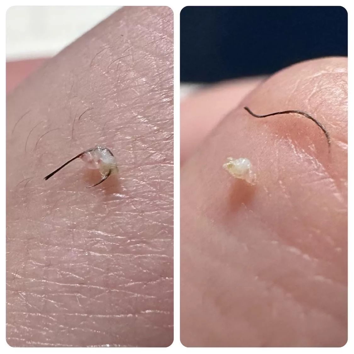 Pubic region ingrown was juicier than I expected