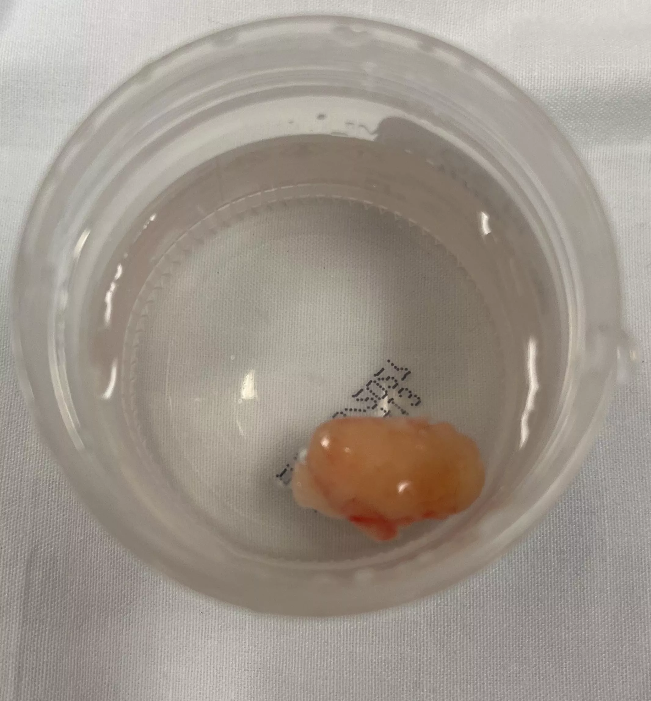 Lipoma Removal Today