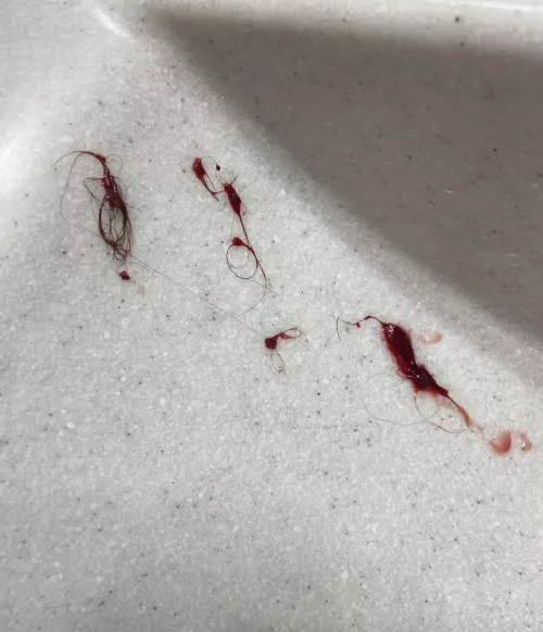 My poor husband pulled this out of my ass (pilonidal cyst)