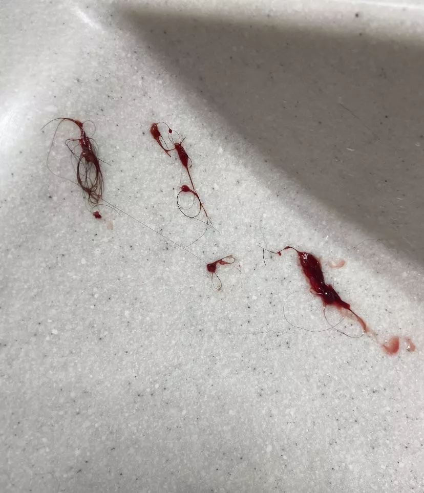My poor husband pulled this out of my ass (pilonidal cyst)