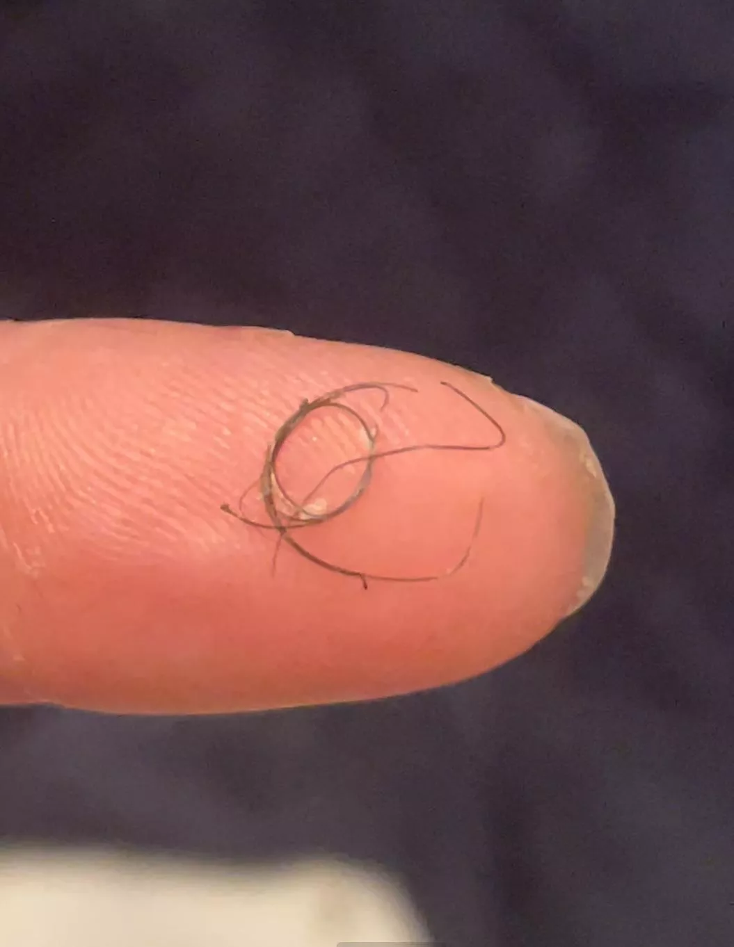 I unwound this hair from under my skin and around a “zit” it was forming and it healed but why’d this happen at all?