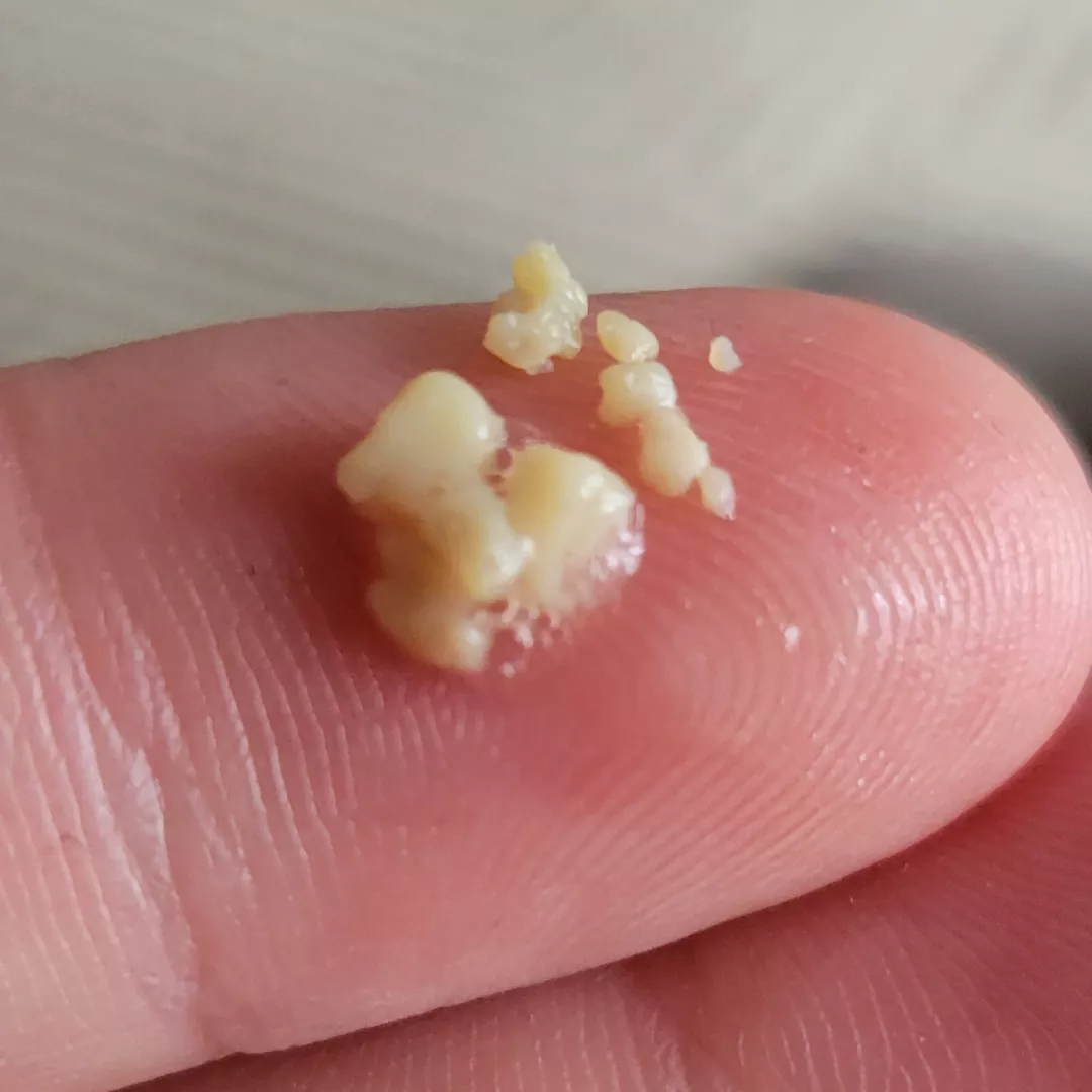 Thought there was a peanut stuck in my throat. Nope. Tonsil stones