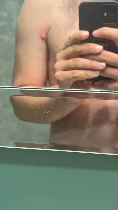 Idek what you call this , never had a pimple get this big, was satisfying to pop but it’s still a bit swollen