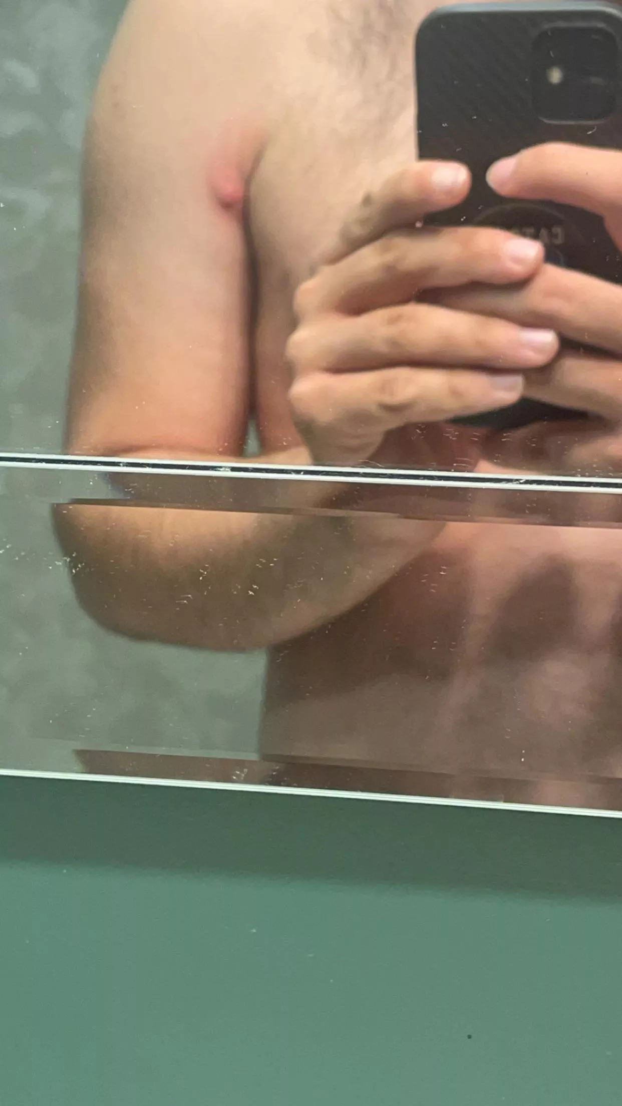 Idek what you call this , never had a pimple get this big, was satisfying to pop but it’s still a bit swollen