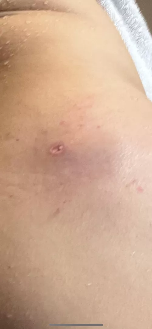 abcess removed still open