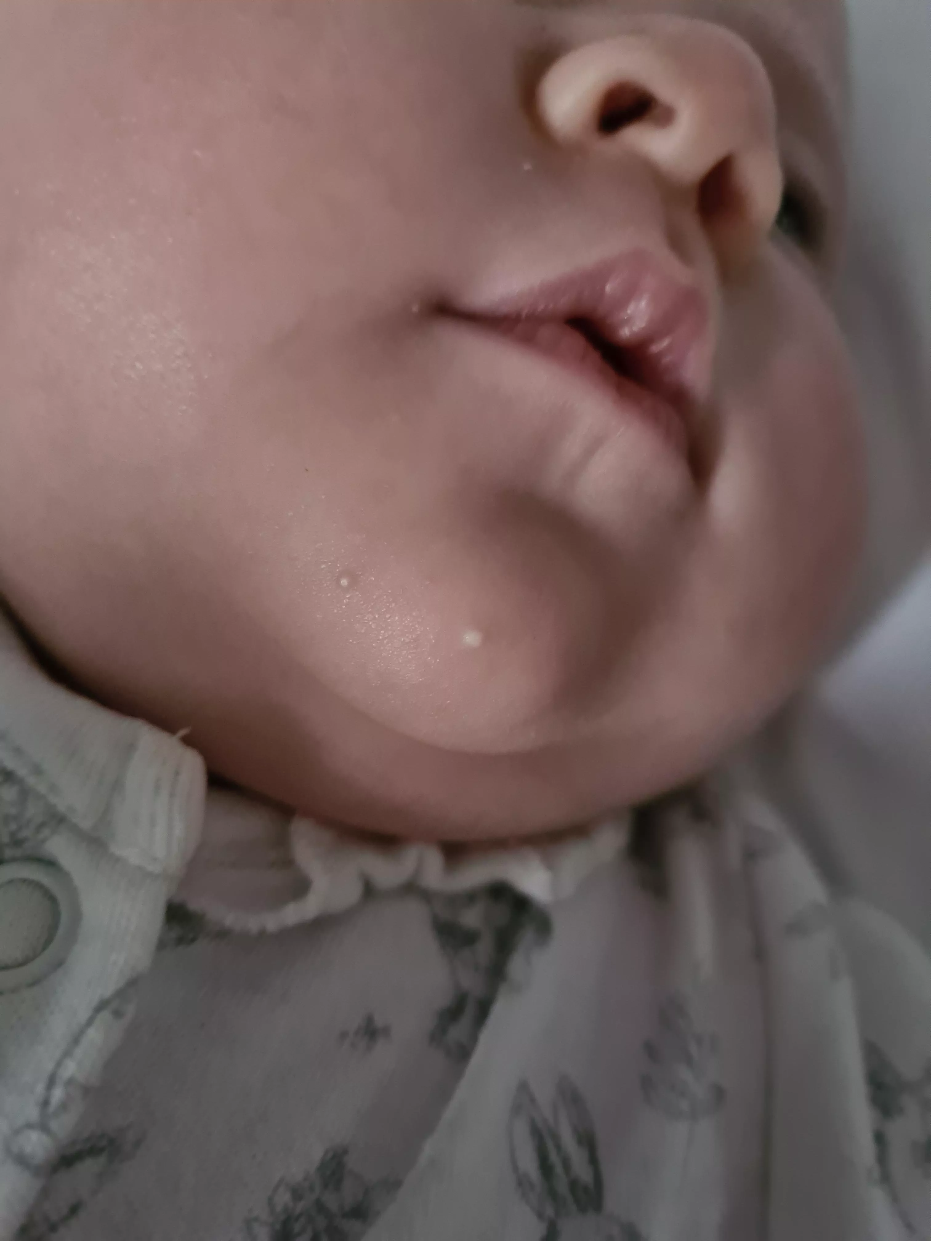 This spot has been on my 2 month old chin since birth and it kills me I can't pop it