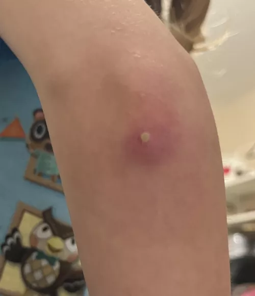 Is this just a zit or worse?