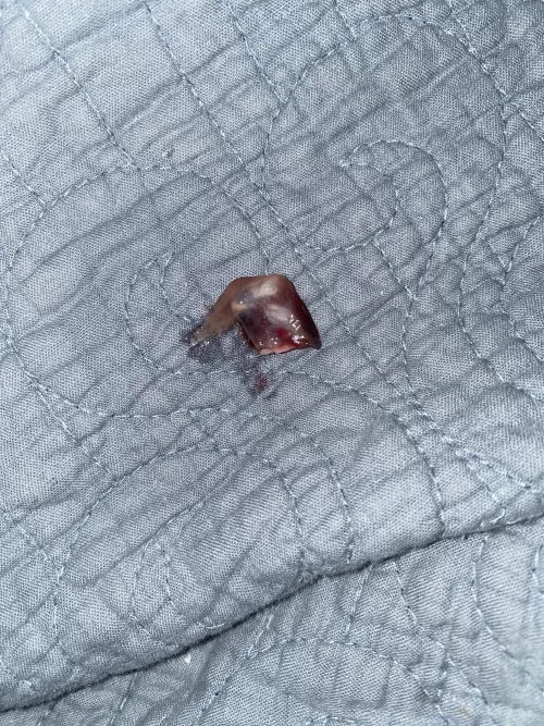 5 day post-op clot that came out of nose