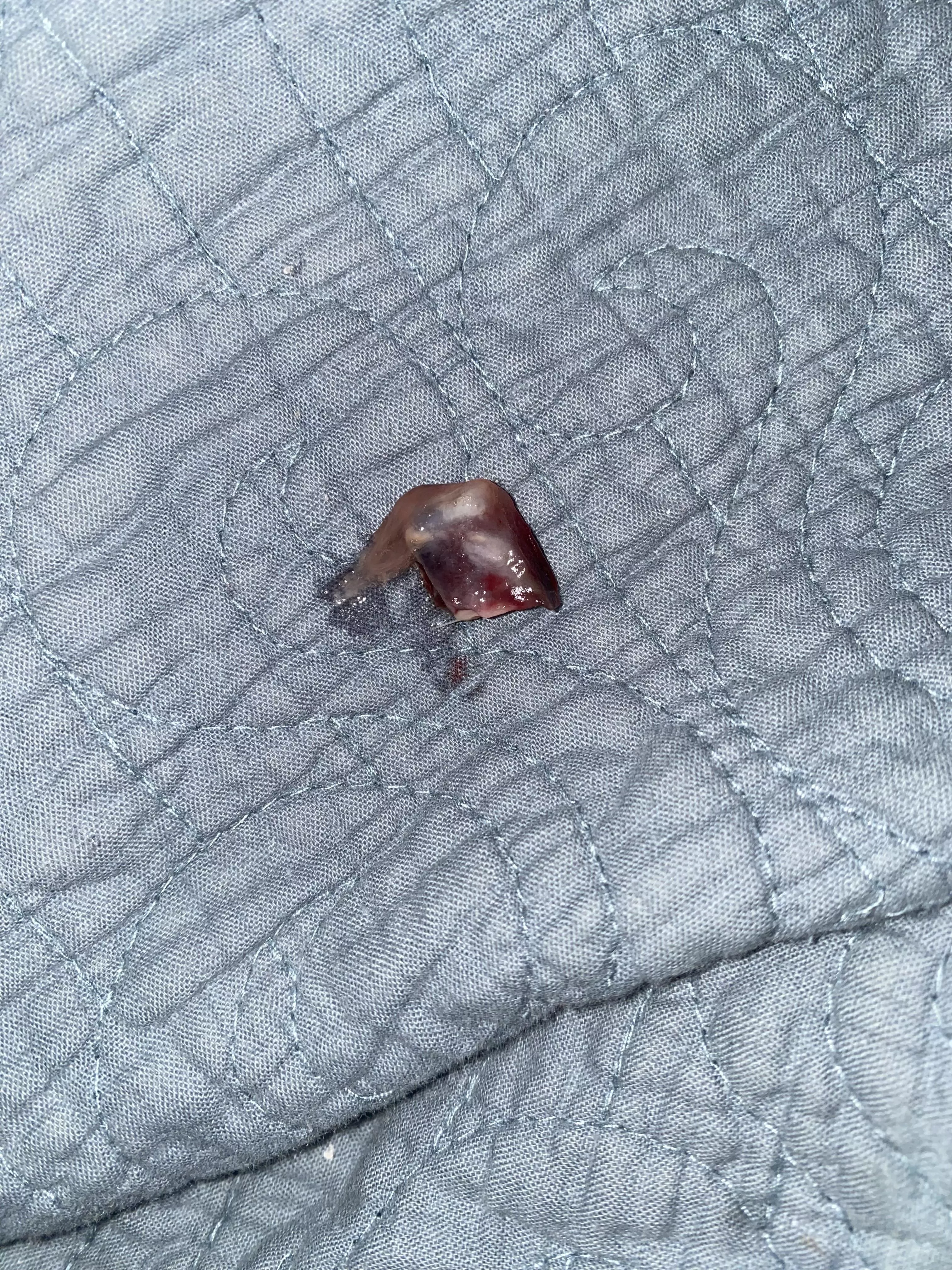 5 day post-op clot that came out of nose