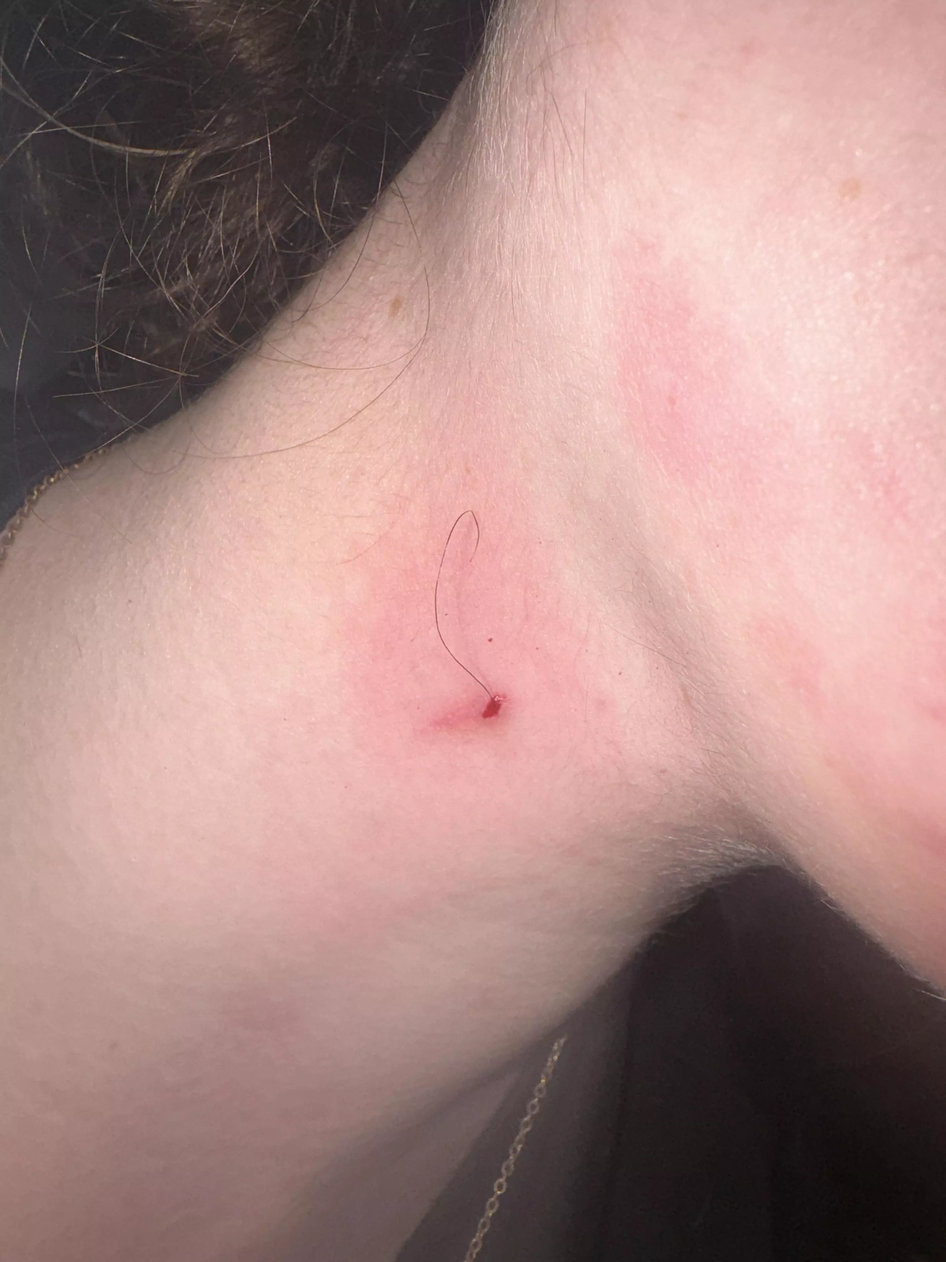 ingrown hair i’ve had on my neck for months😭
